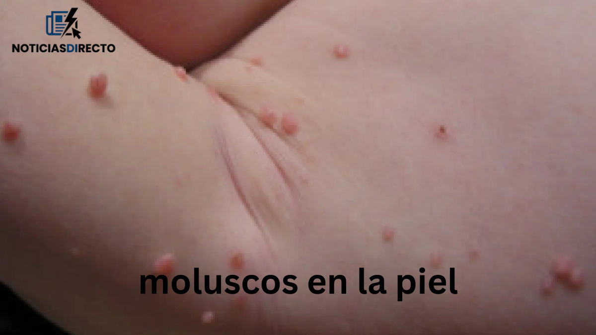 Moluscos en la piel niños: qué son y qué hacer